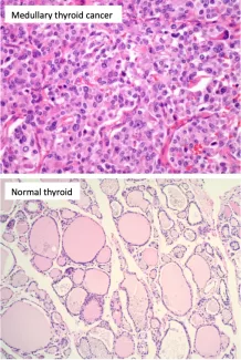 Medullary Thyroid Cancer