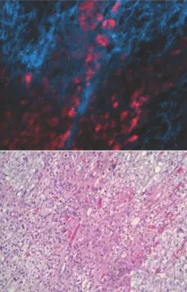 Visualization of adrenal tumors using near-infrared autofluorescence