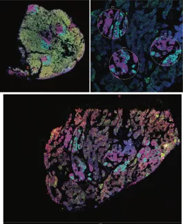 Digital spatial profiling of human parathyroid tissue